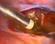 Video removal of the uterus using the Laparoscope (Laparoscopic Hysterectomy)