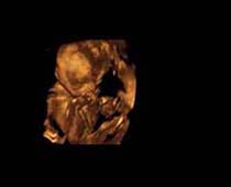 3D Ultrasound of Second Trimester Fetus 10